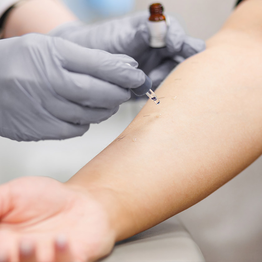 Prick-Test am Arm einer Patientin zum Test auf Allergien in der Praxis HNO am Neckar. 